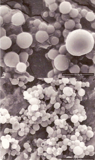 Photomicrograph of urine spheres